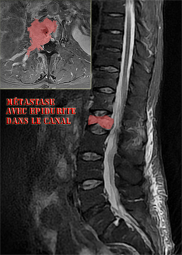 Métastase avec épidurite