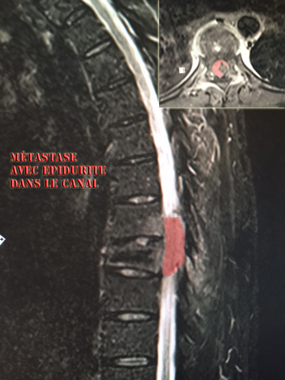 Compression médullaire par épidurite