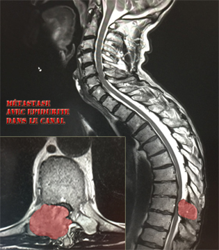 Métastase avec épidurite